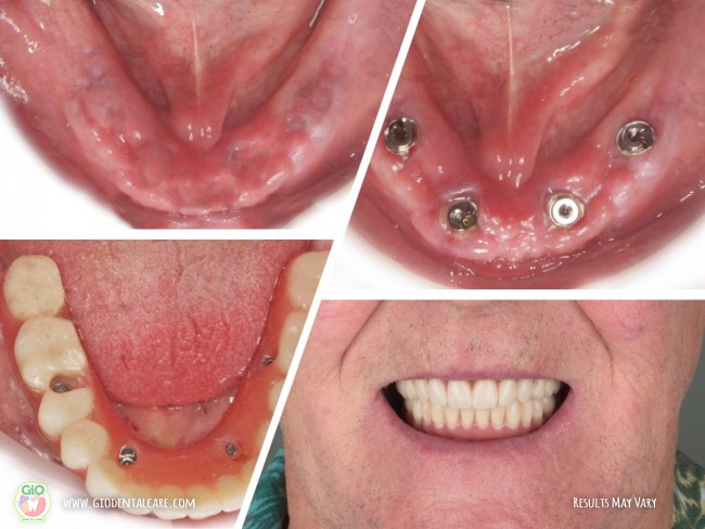 gio-dental-implants--implan-gigi